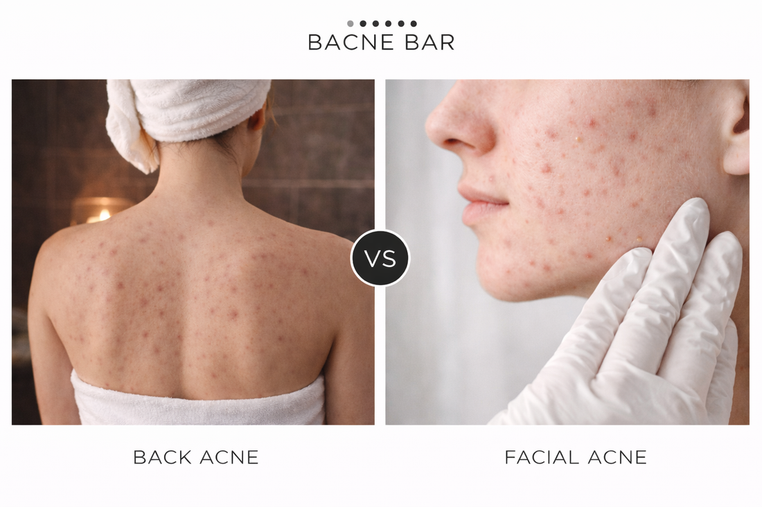 back acne vs facial acne