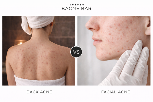 back acne vs facial acne